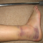 sprained-ankle