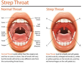 STREP-THROAT-Pain-in-the-throat